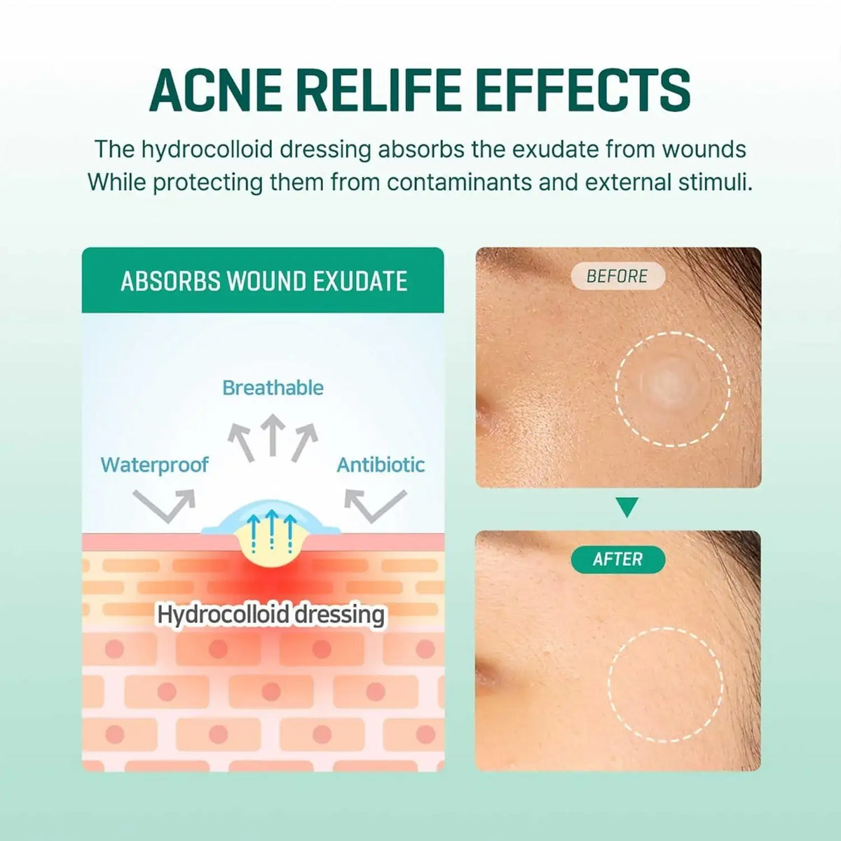 SomeByMi Korean hydrocolloid patch product view 7